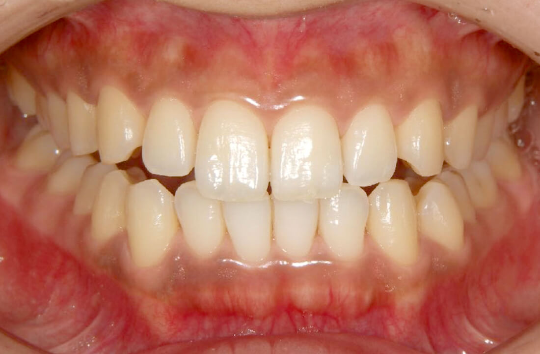 初期の歯周病に対する治療