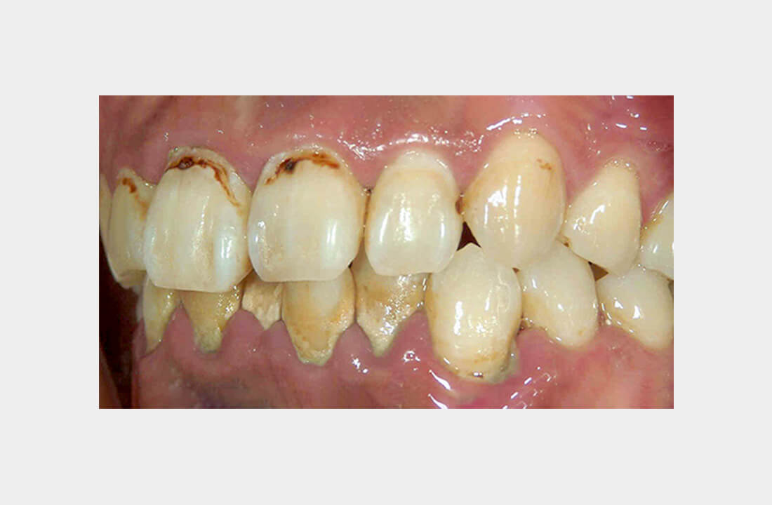 中等度・重度の歯周病に対する治療
